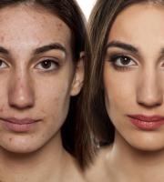 Θεραπείες ακμής