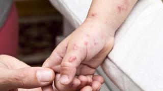 ΕΟΔΥ: Αύξηση περιστατικών Κοξάκι σε παιδιά και συστηνόμενα προληπτικά μέτρα 