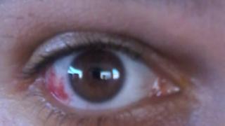 Αλεξ/πολη: Στο νοσοκομείο στρατιώτης μετά από ξυλοδαρμό.