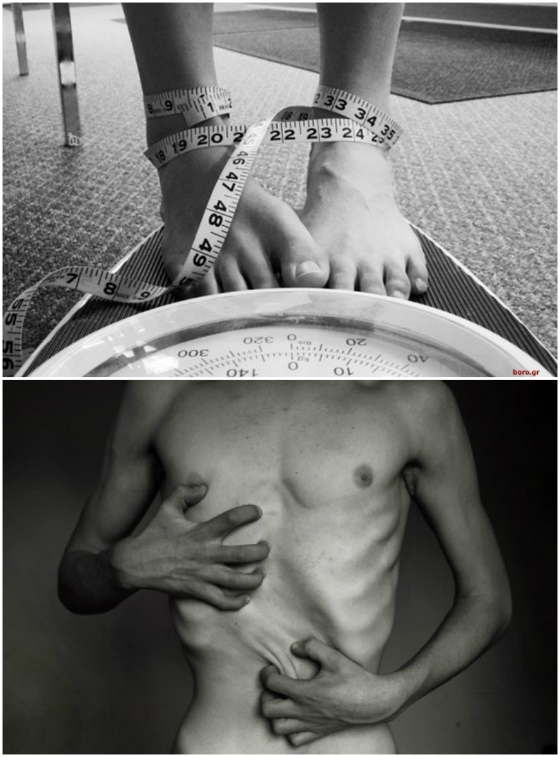 Ψυχογενείς Διατροφικές Διαταραχές: Παχυσαρκία, Νευρογενής Βουλιμία, Νευρογενής Ανορεξία