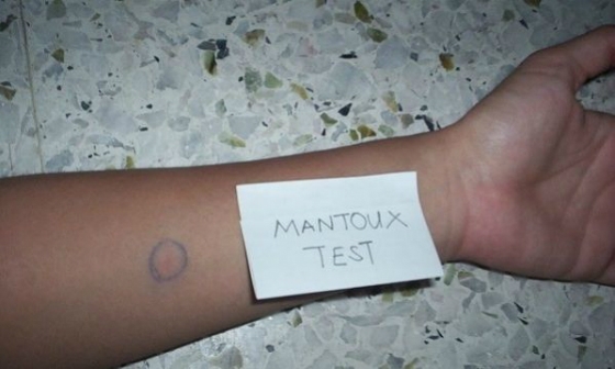 θα ολοκληρωθούν μέσα στο μήνα Μάιο, σε όλους τους μαθητές των νηπιαγωγείων του Δήμου Αλεξανδρούπολης τα test Mantoux 