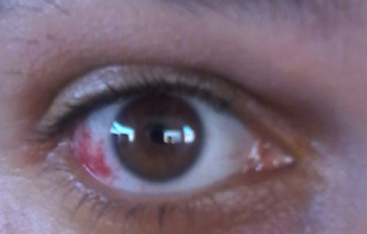 Ο 24χρονος στρατιώτης τραυματίστηκε στο δεξί μάτι (φωτο) αλλά και το αριστερό πόδι.